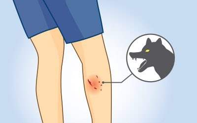 What You Should Do After A Dog Bite In Houston?