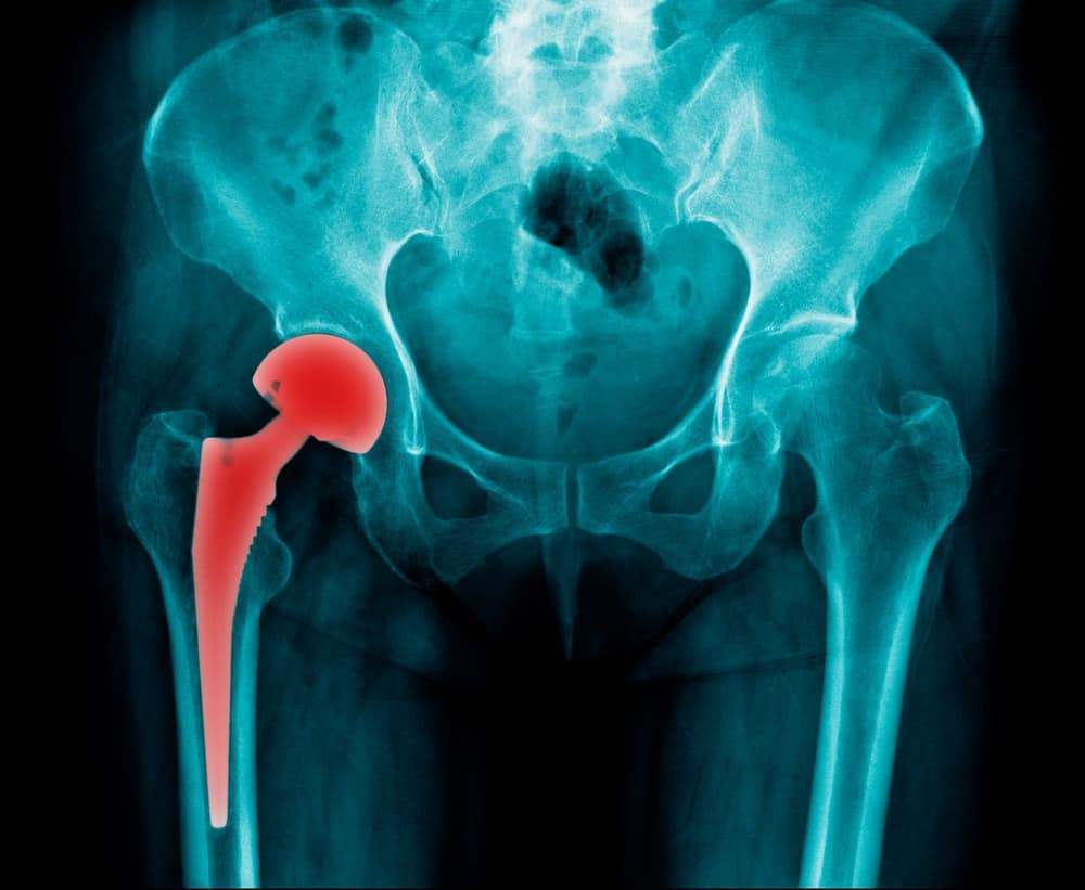 Hip Replacement Gets Infected