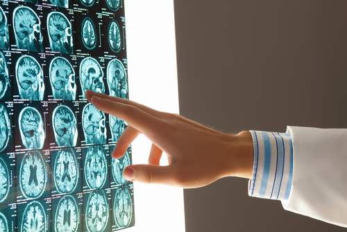 Why Do Traumatic Brain Injury Claims Have Such Large Verdicts & Settlements?