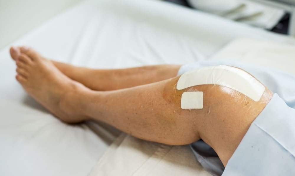 Knee Replacement Gets Infected